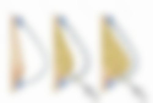 身体肥胖抽脂后反弹问题剖析