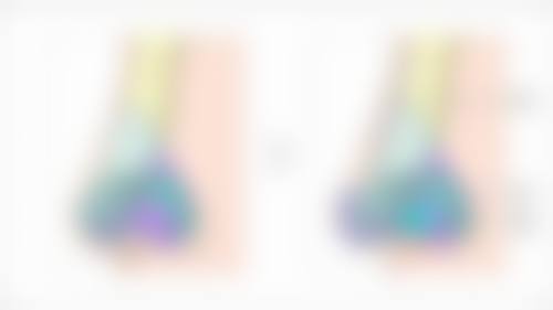 自体脂肪移植隆胸的成效好吗:与假体隆胸成效对比