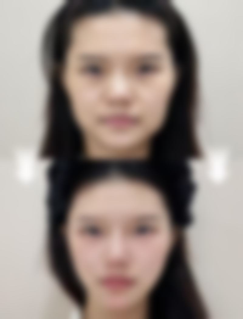 身体肥胖抽脂适宜人群分析