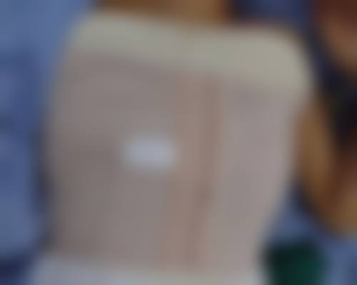 发际线多久可以二次种植:二次种植时间与更终成效的紧密关系