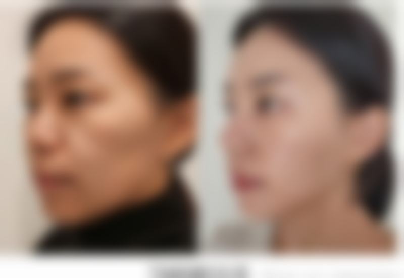泰国Asia(亚洲)整形医院价格表怎么样