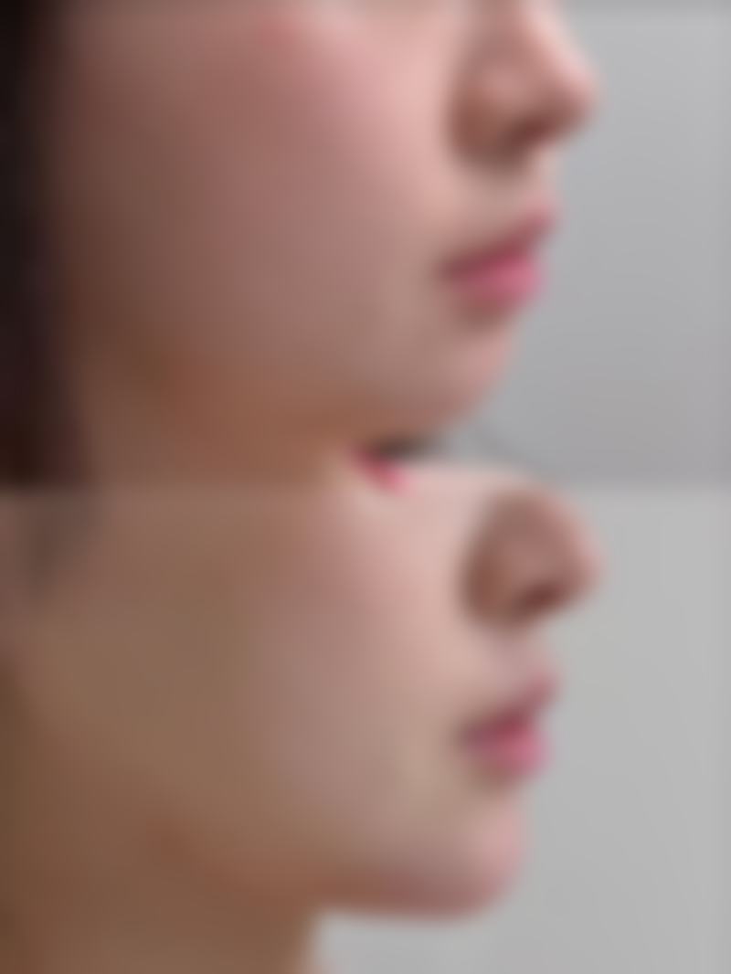 杭州悦可医疗美容诊所邹霞的透明质酸注射注意事项:呵护美丽成果