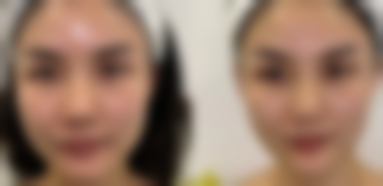 杭州悦可医疗美容诊所邹霞的透明质酸与肉毒素协同:美丽1 + 1 > 2