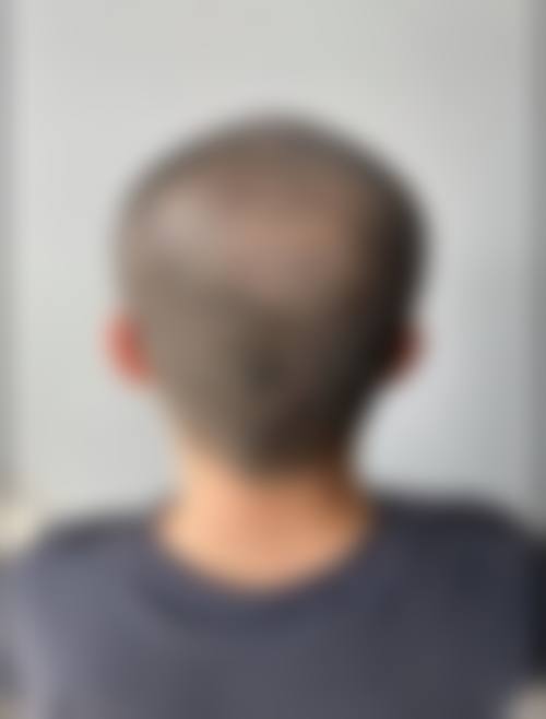 北京雍禾植发新兴桥医疗美容诊所价格表