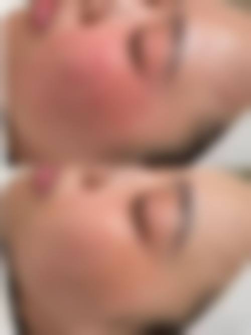 优惠活动详情:双眼皮、鼻部整形限时特别优惠